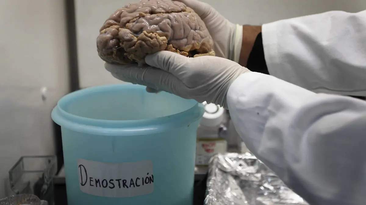 Alzheimer Voz América